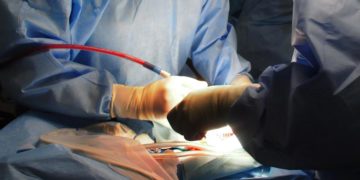 Tumore da rene a cuore rimosso col robot, operazione record a Milano