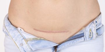 Parto cesareo: consigli per tornare in forma velocemente