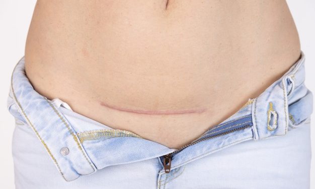 Parto cesareo: consigli per tornare in forma velocemente