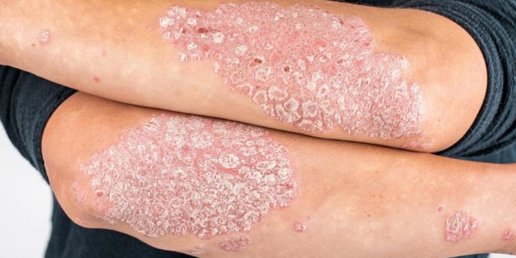 In Italia 1,5 mln persone con psoriasi, per Giornata mondiale campagna social
