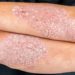 In Italia 1,5 mln persone con psoriasi, per Giornata mondiale campagna social