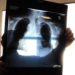 Esperto: “Iter frammentato diagnosi cancro polmone crea errori”
