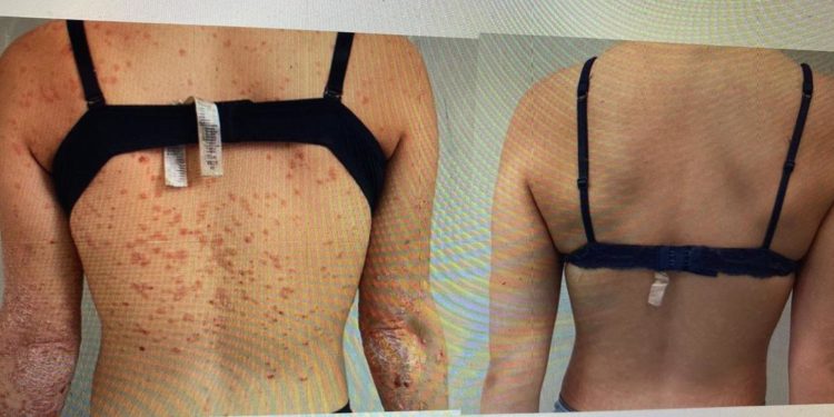 Fabbrocini (Federico II): “Biologici migliorano pelle pazienti psoriasi”