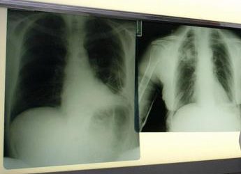 Cancro polmone in stadio precoce: con nuova terapia 88% pazienti vivo a 5 anni