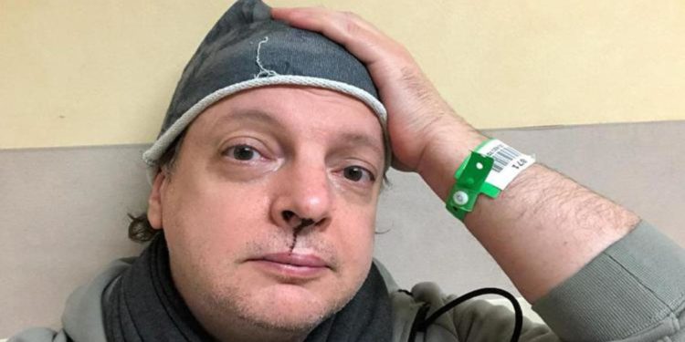 Dado rinviato a giudizio: “Grottesco, secondo loro mi sono rotto il naso da solo”