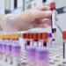 Test del sangue può escludere rischio demenza fino a 10 anni prima, lo studio