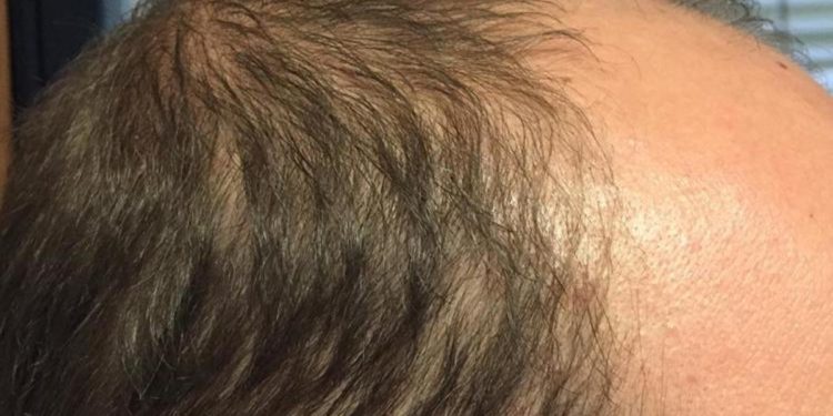 Covid, perdita di capelli per 1 su 3 dopo infezione