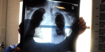 Tumore del polmone, -5mila morti l’anno con screening Tac bassa dose