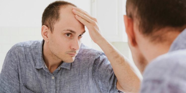 Alopecia areata, approvato dalla FDA nuovo farmaco