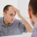 Alopecia areata, approvato dalla FDA nuovo farmaco