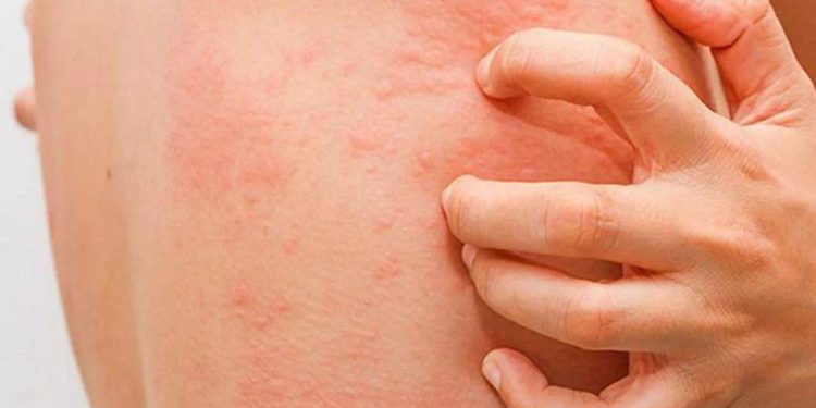 Covid e Herpes Zoster, Andreoni: “Che virus si riattivi non sorprende”