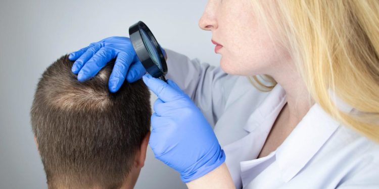 Alopecia areata, 1,2 mln italiani con perdita peli e capelli: c’è la terapia