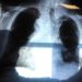 Tumori, Pastorino (Int): “Screening polmonare nei Lea per prevenzione globale”