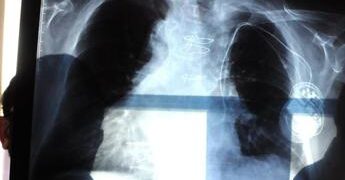 Bpco, pneumologa Foschino Barbaro: “Nella donna sintomi diversi, attenzione alle giovani”