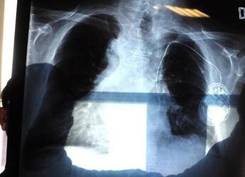 Bpco, pneumologa Foschino Barbaro: “Nella donna sintomi diversi, attenzione alle giovani”
