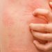 Orticaria cronica spontanea, come migliorare percorso di cura paziente