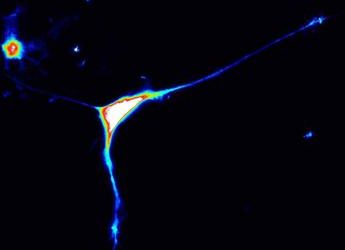 Scoperto un gene che causa l’autismo, è il Caprin1