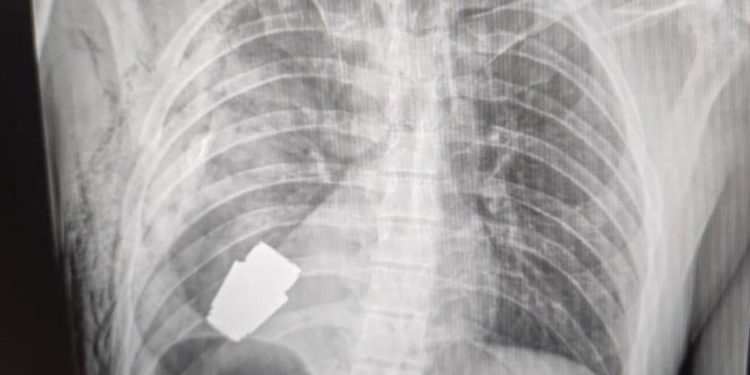 Granata nel torace del soldato, l’operazione in Ucraina