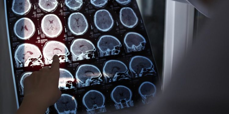 Alzheimer a 19 anni, segnalato caso più precoce al mondo