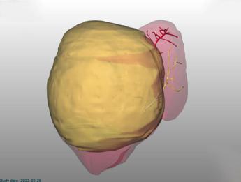Roma, rimosso tumore di 2 kg da fegato bimba di 10 mesi al Bambino Gesù