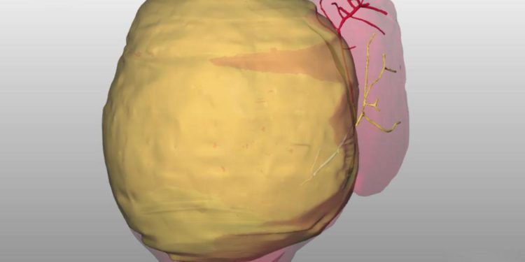 Roma, rimosso tumore di 2 kg da fegato bimba di 10 mesi al Bambino Gesù