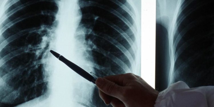 “Tubercolosi in ripresa, ricomincia a fare paura”