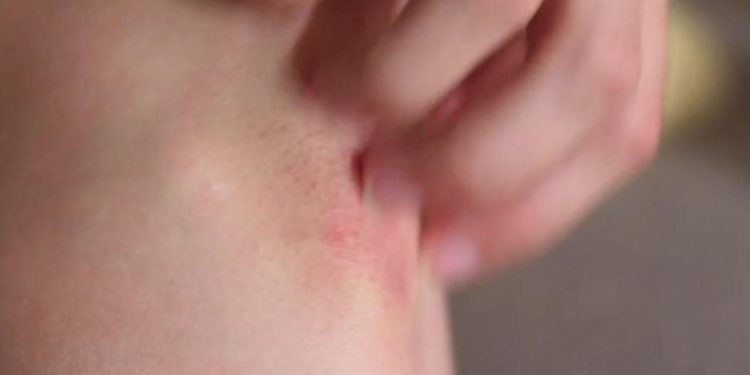 Psoriasi a placche, approvazione Ce per primo inibitore TYK2