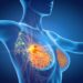 Cancro mammella: -25% rischio recidiva con ribociclib dopo chirurgia