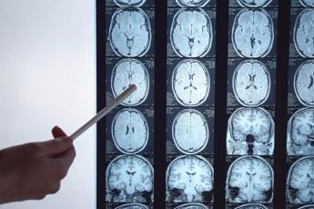 Glioblastoma, scoperto indice che predice la sopravvivenza