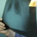 Ipertensione arteriosa polmonare, risultati promettenti per nuova molecola Msd