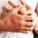 Psoriasi per 1,8 mln italiani, Salutequità e Apfiaco: “Entri in Piano cronicità”