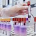 Anemia Fanconi, scoperta ‘firma molecolare’ per diagnosi più rapida