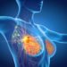 Cancro seno in stadio precoce, farmaco riduce del 32% rischio recidiva a 5 anni