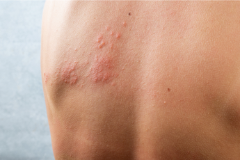 Dardani (Sir): “Herpes Zoster più rischioso per pazienti reumatologici”