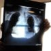 Tumori, in Italia 395mila casi nel 2023, ondata diagnosi post pandemia e -3% screening