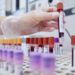Cancro alla vescica, scoperto ‘interruttore’ molecolare utile per nuove cure
