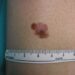 Cancro, oncologo: “Tre anni per vaccino mRna contro melanoma”
