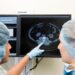 Kinsella e il cancro al cervello, cos’è il glioblastoma che l’ha colpita