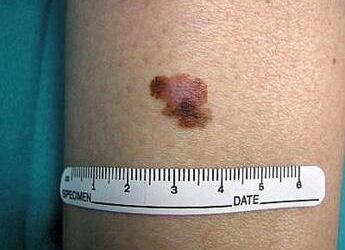 Melanoma, boom nei giovani: è il cancro più comune negli under 30