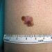 Tumori, contro melanoma il virus dell’herpes modificato funziona: lo studio