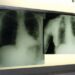 Cancro polmone, Int e Politecnico Milano con Msd per innovare gestione pazienti
