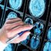 Iss, scoperto meccanismo chiave Alzheimer, speranza per diagnosi e cure