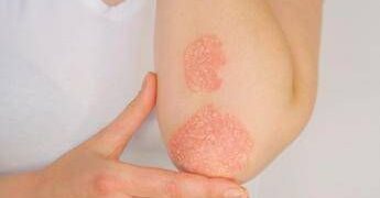 Psoriasi, dati positivi per inibitore orale di Tyk2 di nuova generazione
