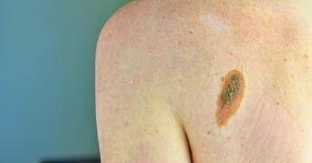 Melanoma, Ascierto (Scito): “Con immunoterapia più speranze per metà forme gravi”