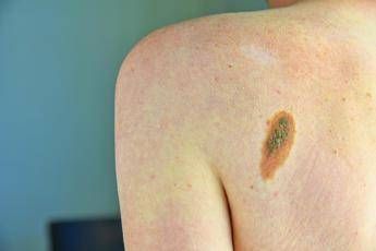 Prevenzione melanoma, Sidemast pronta a collaborare per percorsi chiari