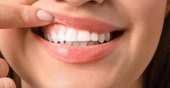 Denti a rischio tra i giovani, Sidp: “Il 36% della Gen Z ha gengive che sanguinano”