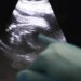 Trapianti, Uk, Amy prima bimba nata da donazione di utero da vivente