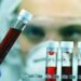 Giornata patologie eosinofile, ematologa Iurlo ‘fino a 5 anni per diagnosi’