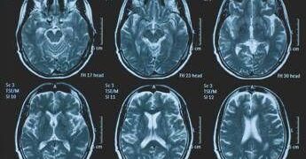 Tumori, glioma pediatrico di basso grado: via libera in Europa a prima terapia mirata