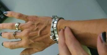 Torna la scabbia, in Italia +750% casi in 3 anni. L’overtourism tra le cause